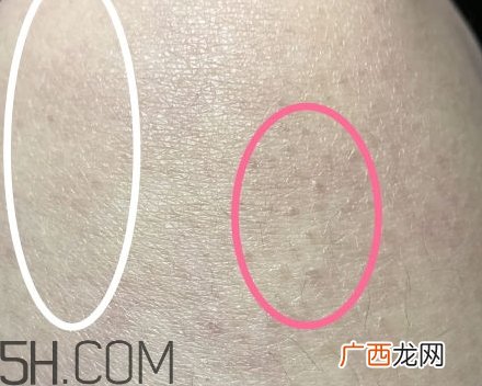 水杨酸可以去黑头吗？水杨酸可以去闭口吗