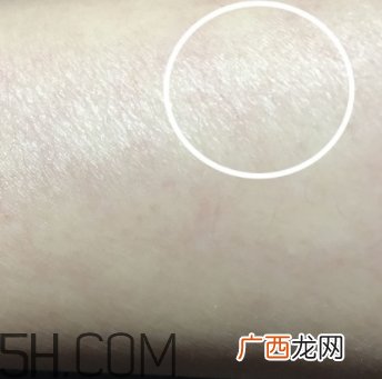 水杨酸可以去黑头吗？水杨酸可以去闭口吗