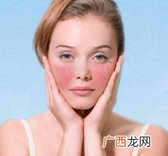 脸上紫外线过敏怎么办，什么药膏可以治紫外线