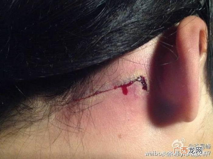 李易峰疤痕，李易峰古剑受的伤这疤痕可能一辈子为苏苏留下的印记