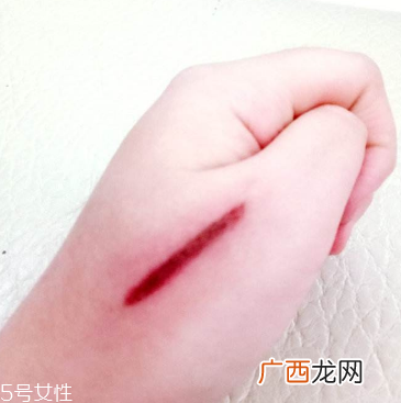 创可贴和肉连着怎么办？创可贴连着肉怎么处理？