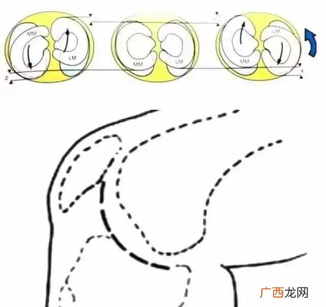 半月板是什么位置 半月板是什么原因引起的