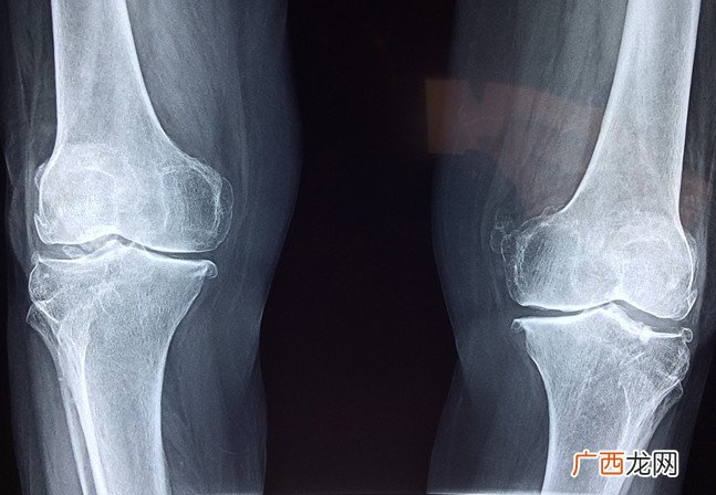 氨糖是什么健力多氨糖了解一下