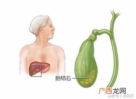 胆囊结石不能吃什么食物（胆囊结石饮食注意事