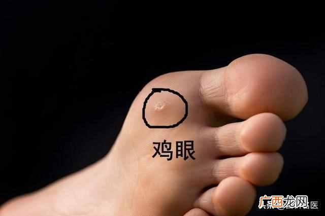 鸡眼是怎么造成的 为什么会长鸡眼在脚上