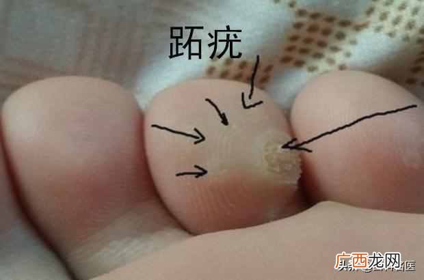 鸡眼是怎么造成的 为什么会长鸡眼在脚上
