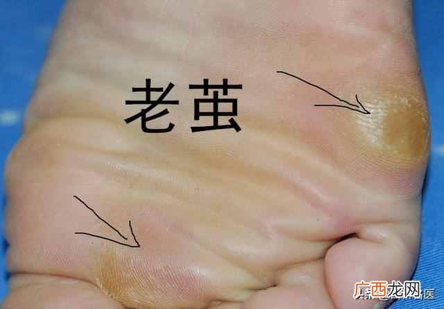鸡眼是怎么造成的 为什么会长鸡眼在脚上