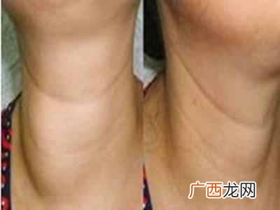 甲亢有哪些症状 什么是甲亢病
