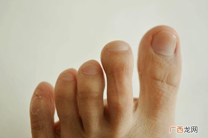 脚趾甲内长，脚指甲长到肉里面