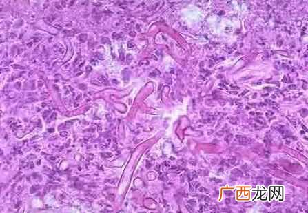 霉菌性阴炎用什么药好得快（霉菌性阴炎有哪些