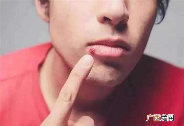 帮你从根本上解决问题 嘴角烂是什么原因