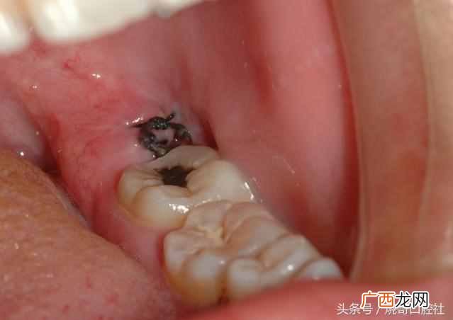 快速消炎止痛好食疗 拔牙后吃什么食物