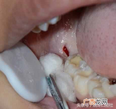快速消炎止痛好食疗 拔牙后吃什么食物