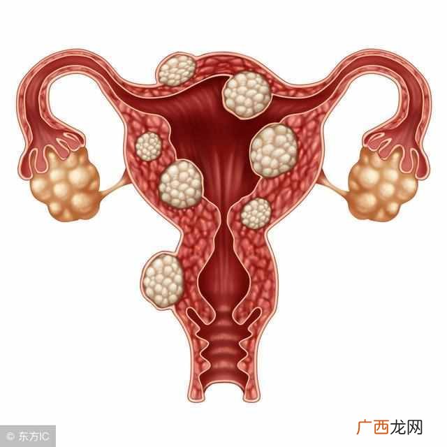 子宫肌瘤有哪些症状 为什么会得子宫肌瘤