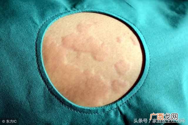 寻麻疹造成的原因及治疗方案 什么是寻麻疹