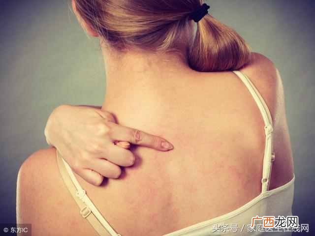 寻麻疹造成的原因及治疗方案 什么是寻麻疹