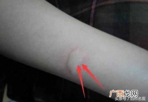 谁是蚊子的菜呢 蚊子喜欢什么血型