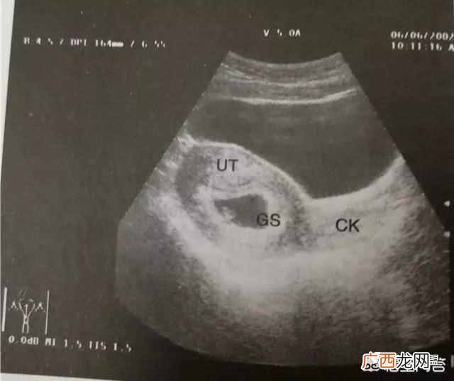 胎芽胎心是什么 胎芽是什么样子