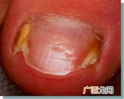 教你如何治疗灰指甲 灰指甲挂什么科