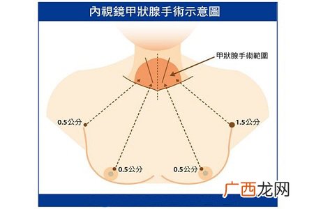 脖子不留疤从乳晕切除甲状腺肿瘤