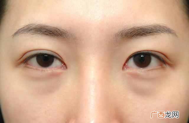 卧蚕和眼袋的区别 卧蚕是什么样子