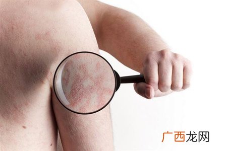 干癣是怎么引起的?3成患者得关节炎