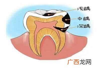 一般补牙用什么材料好（带你了解最受欢迎的几