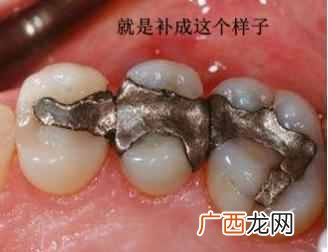 一般补牙用什么材料好（带你了解最受欢迎的几