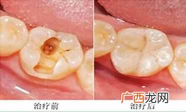 一般补牙用什么材料好（带你了解最受欢迎的几