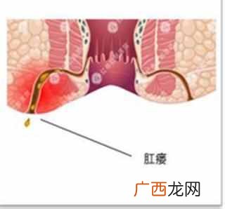 肛瘘最全的治疗方案 什么是肛瘘有哪些症状