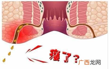肛瘘最全的治疗方案 什么是肛瘘有哪些症状