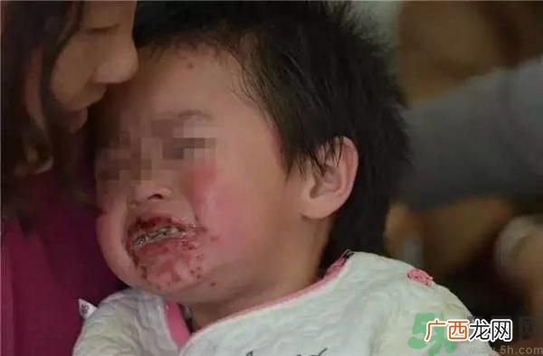 幼童吃辣条嘴巴溃烂成蜂窝常吃辣条的危害有哪些?
