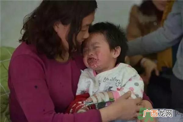 幼童吃辣条嘴巴溃烂成蜂窝常吃辣条的危害有哪些?