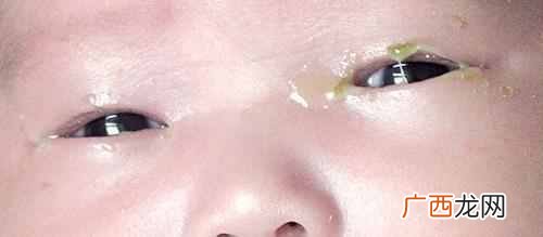 眼睛眼屎多是什么原因（教你一招快速去除眼屎