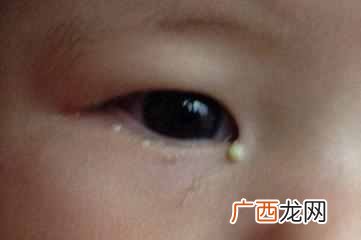 眼睛眼屎多是什么原因（教你一招快速去除眼屎