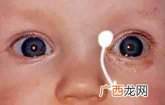 眼睛眼屎多是什么原因（教你一招快速去除眼屎