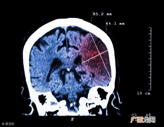 脑血栓饮食注意事项 脑血栓病人吃什么好