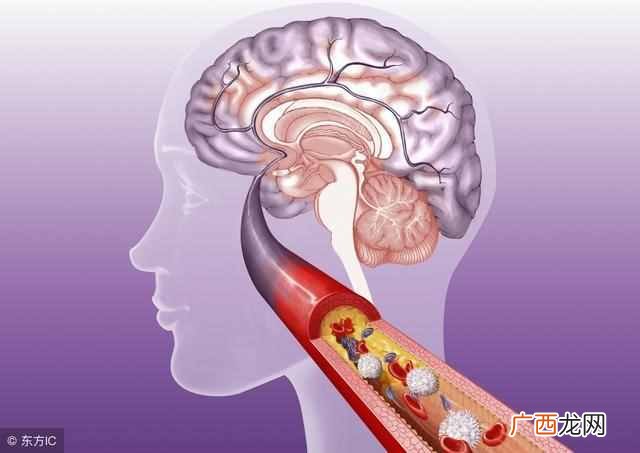 脑血栓饮食注意事项 脑血栓病人吃什么好