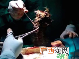 女孩偷吃头发5年吃头发是什么病?