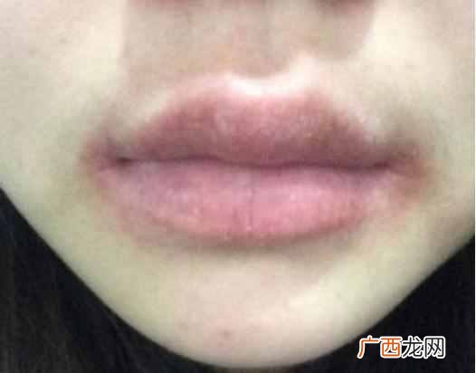 教你几个小窍门 嘴唇干裂是什么原因造成的