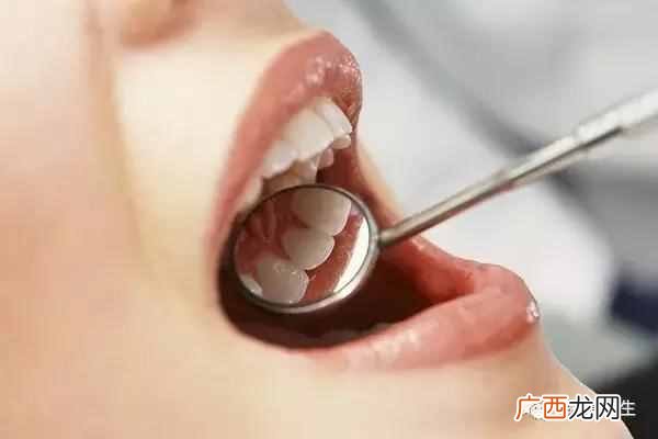 牙结石去除方法 牙石是什么原因引起的