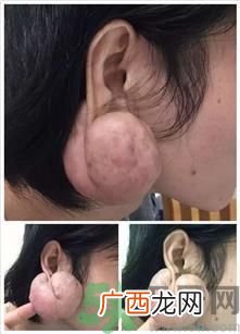 小伙戴耳钉长出大肉瘤,乱打耳洞的危害?