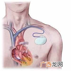 窦性心律不齐是什么意思(窦性心律对人有什么