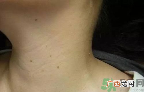 脖子长小肉粒是怎么回事?脖子长小肉粒怎么去除