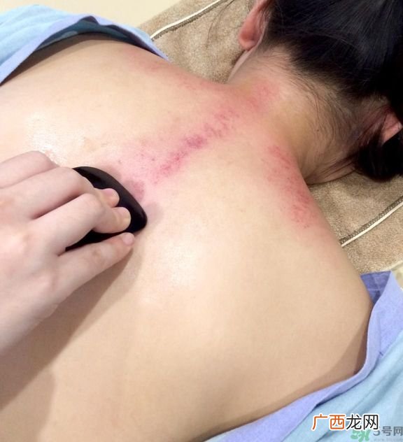 刮痧的好处有那些？夏季刮痧要注意什么？