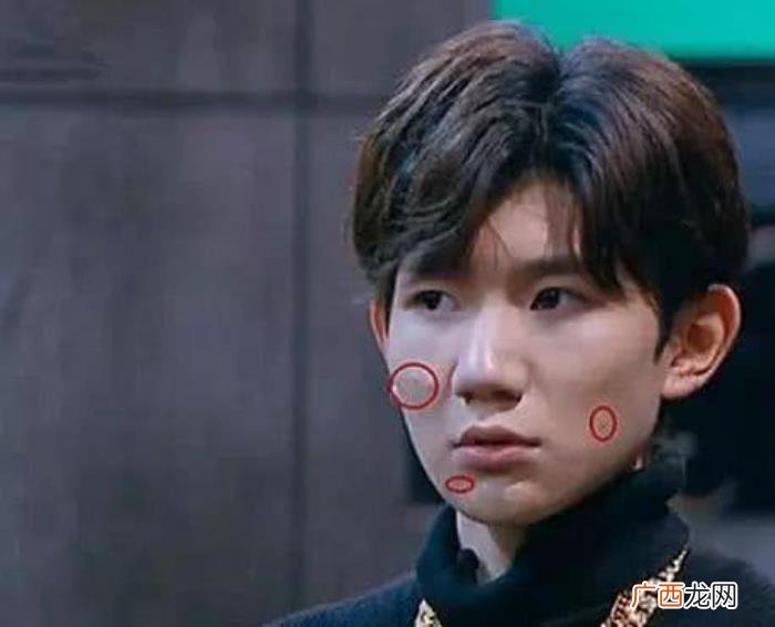 王源长痘痘，王源的痘痘多到不加滤镜都没眼看了