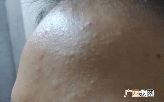 简单几招帮你去除 脸上长粉刺是什么原因