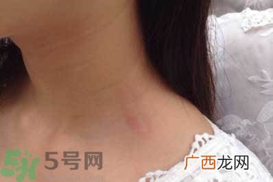 种草莓吻痕是什么意思？吻痕是怎么弄出来的？