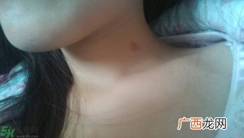 种草莓吻痕是什么意思？吻痕是怎么弄出来的？
