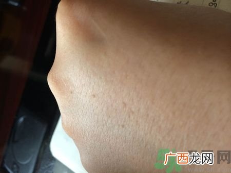 手上长小疙瘩很痒怎么回事?手上长小疙瘩怎么办